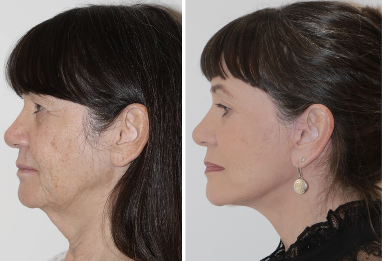 Deep Plane Facelift Surgery Approach London Uk Rajiv Grover 